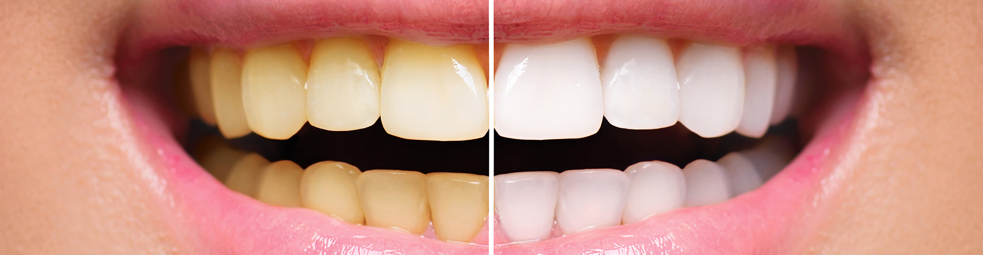 split image of a smile before and after teeth whitening
